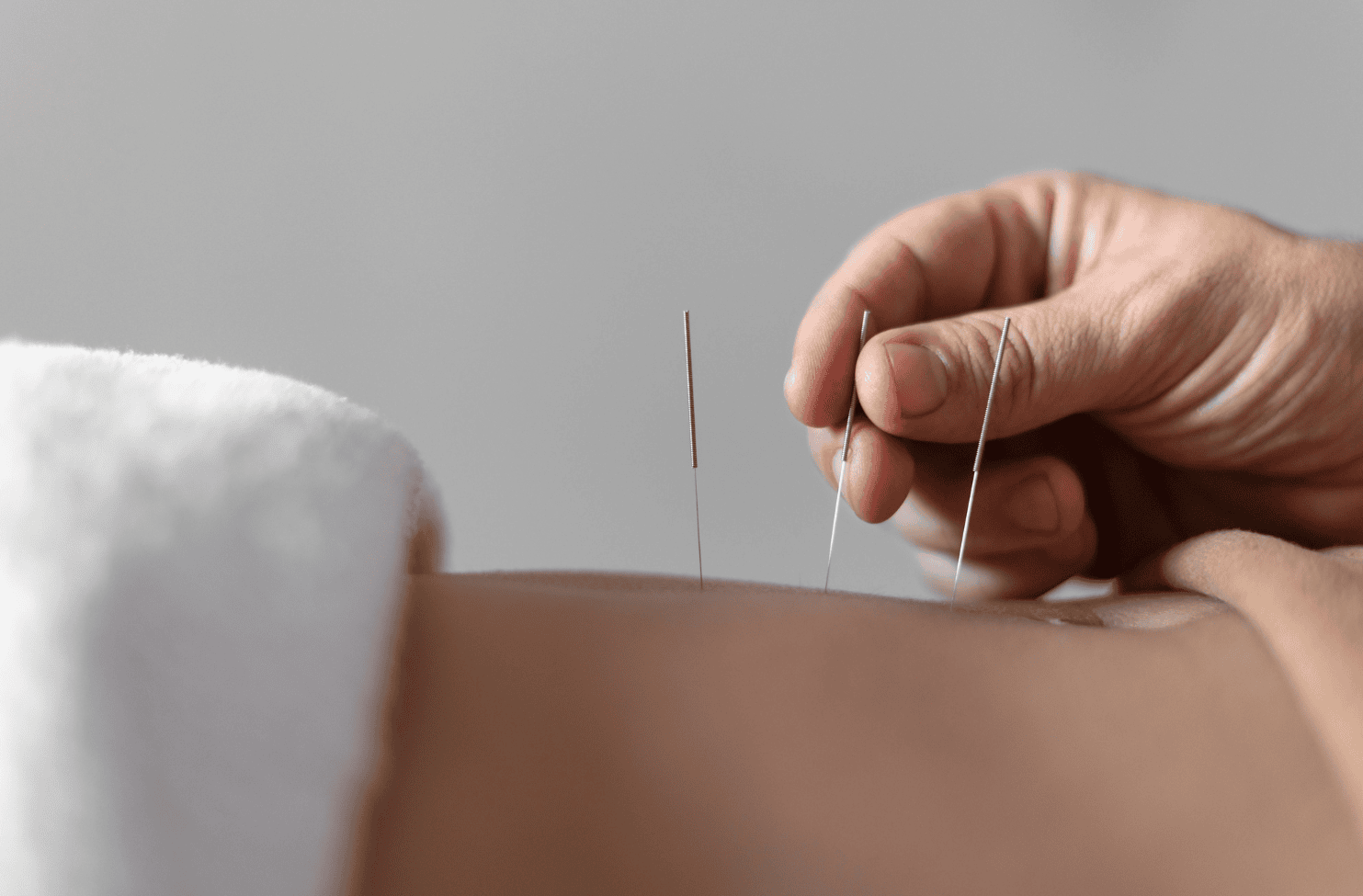 Acupuncture Broadbeach Waters