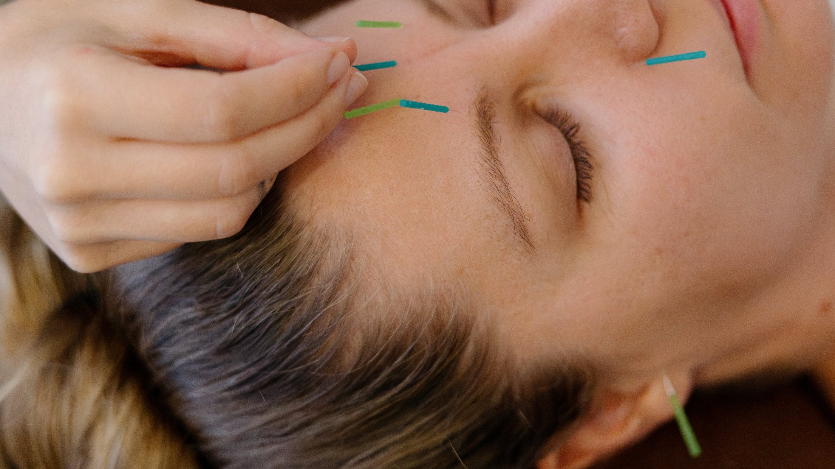 Facial acupuncture treatment at Vyne Health, Miami, Gold Coast