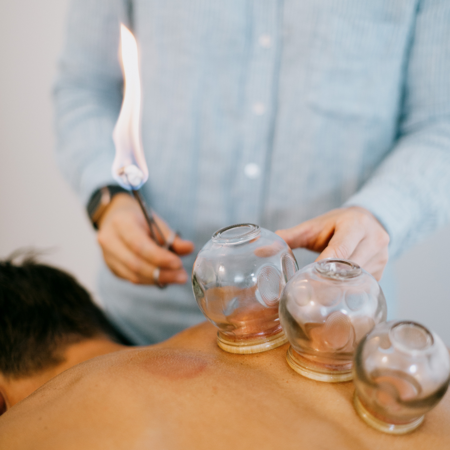 Cupping Gold Coast Vyne Health Acupuncture