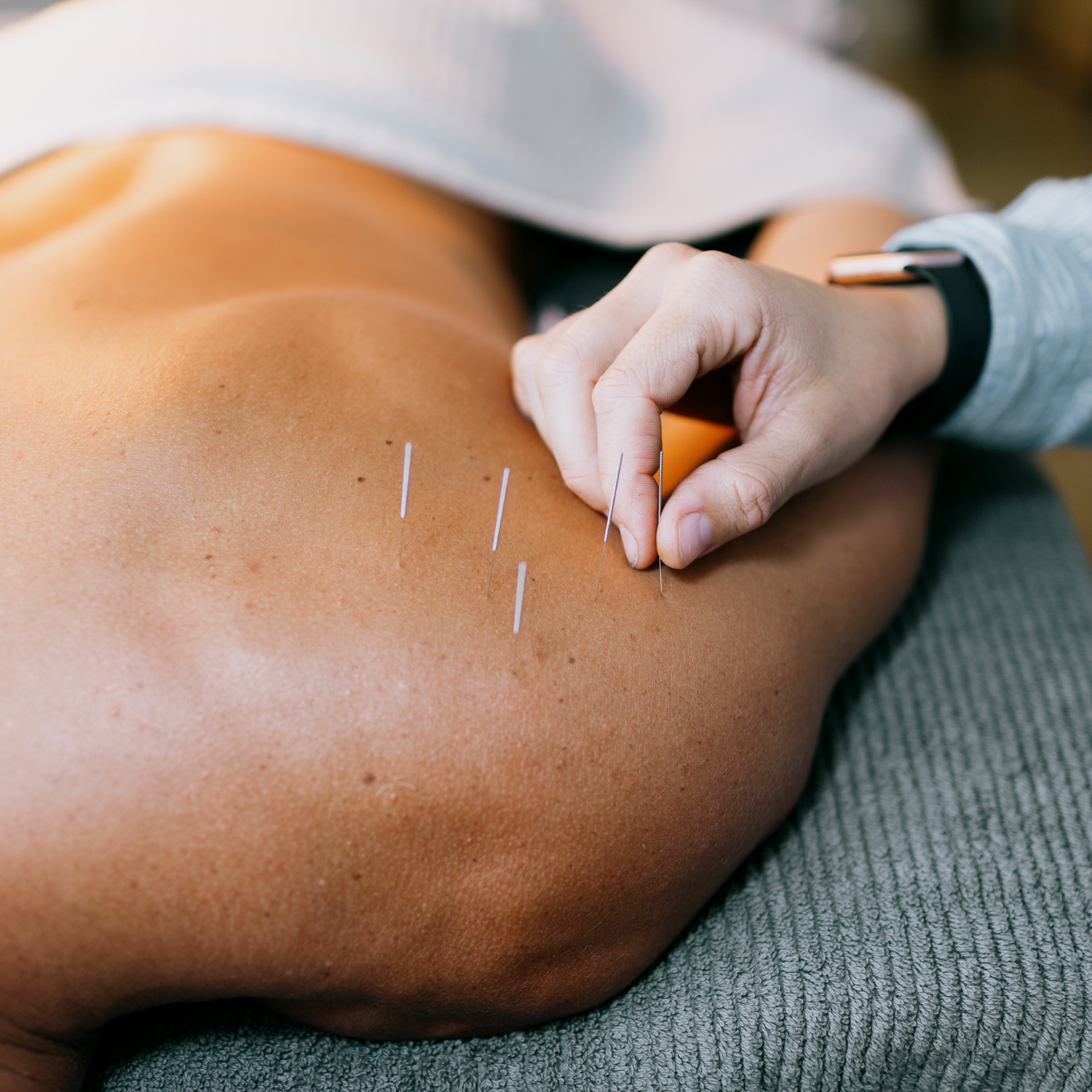 General Acupuncture Gold Coast - Vyne Health