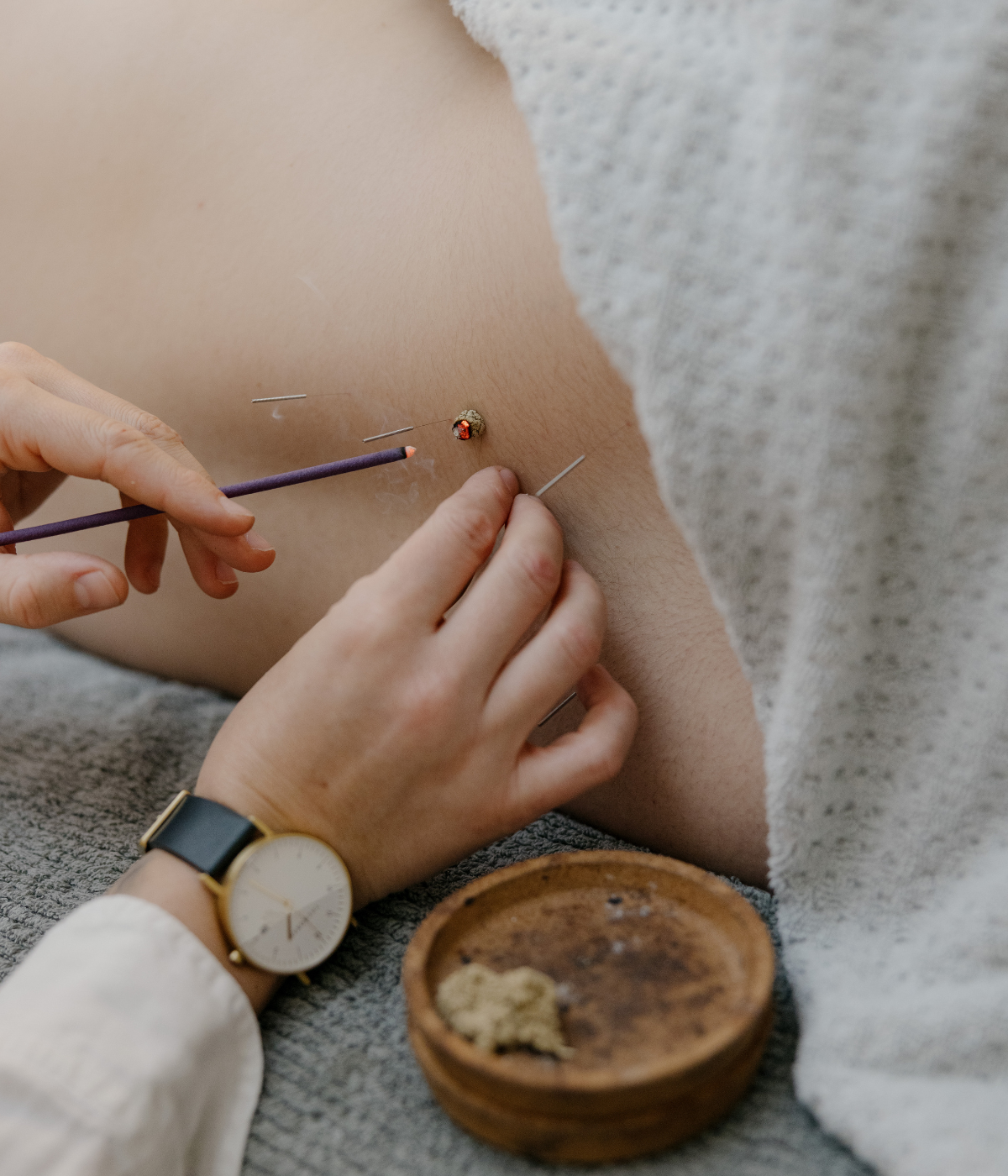 Acupunture Gold Coast - Vyne Health