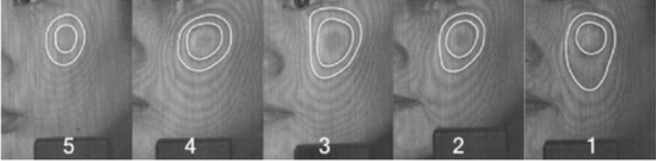 Moiré topography grading series showing facial elasticity changes across five levels, from Yun et al. 2013