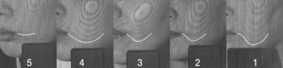 Moiré topography grading criteria showing chin contour changes across five levels, from Yun et al. 2013