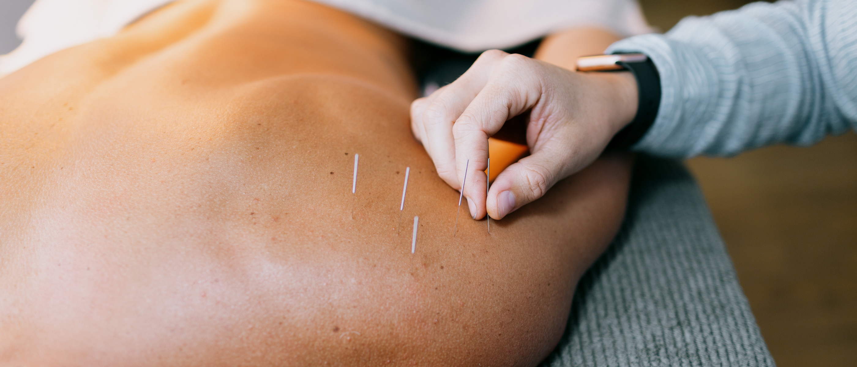 Vyne Health Acupuncture Gold Coast