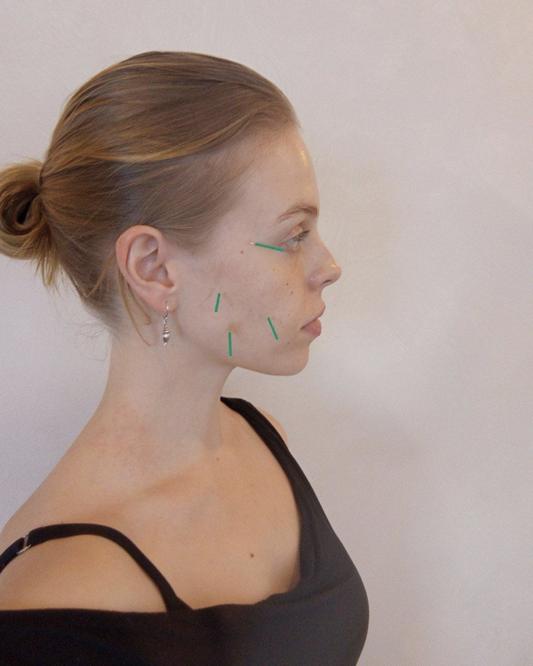 Acupuncture needles placed along the jaw and cheek for jaw tension treatment at Vyne Health